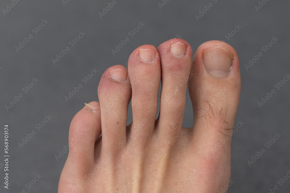The foot, five toes, of a caucasian male with a damaged toe. Underneath