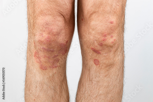 Eczema on knees. Allergic spots and redness of the skin on the legs. Close-up of the legs of a man suffering from psoriasis on a white background.
