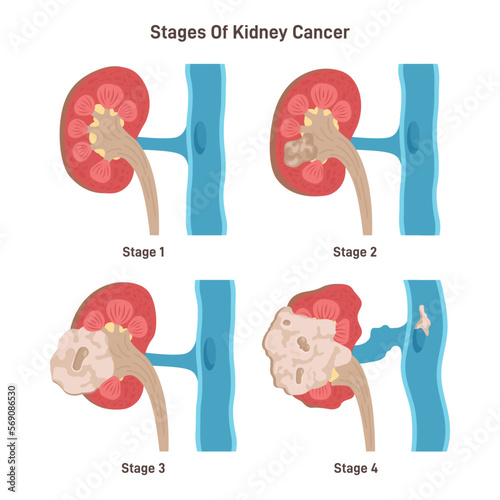Kidney cancer stages. Malignant tumor is affecting a kidney. Development