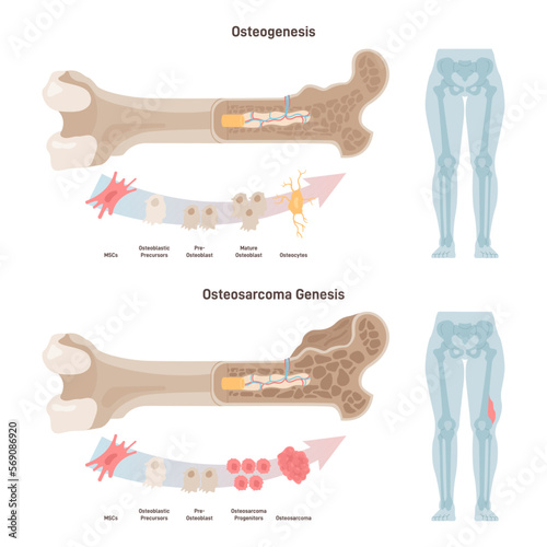 Osteogenesis and osteosarcoma. Cancerous tumor of a human bone photo