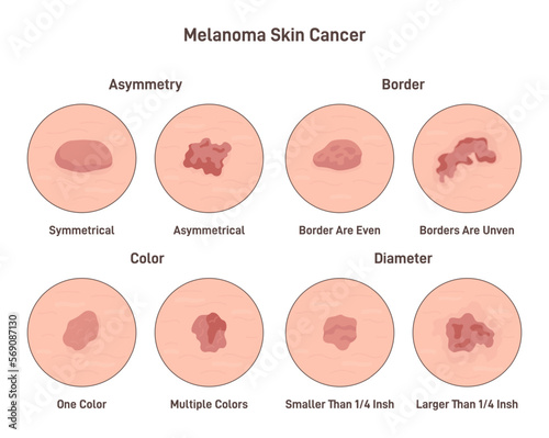Melanoma cancer. Anatomical infographic poster. Dermatology and oncology photo