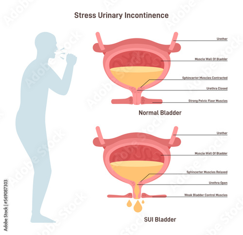 Stress urinary incontinence. Leakage of urine during moments of physical photo