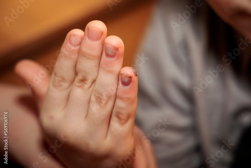 Child's hand with a blood-filled skin blister and blue discolored fingernail due to a bruise © were