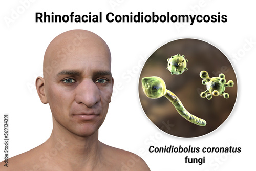 Rhinofacial conidiobolomycosis in a man and Conidiobolus coronatus fungi, 3D illustration. Tropical fungus, causes polyps or under skin masses in nasal cavity photo