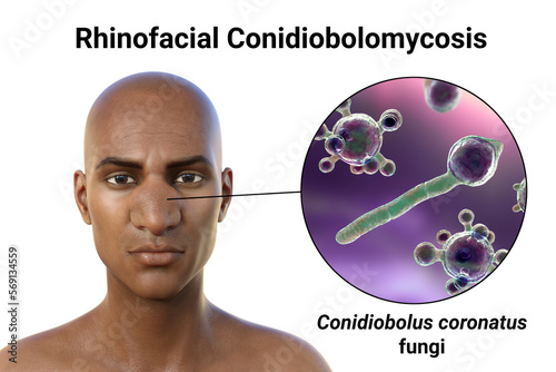 Rhinofacial conidiobolomycosis in a man and Conidiobolus coronatus fungi, 3D illustration. Tropical fungus, causes polyps or under skin masses in nasal cavity photo