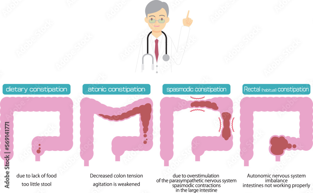 Fototapeta premium 便秘の原因別種類を図解／Illustrated types of constipation by cause