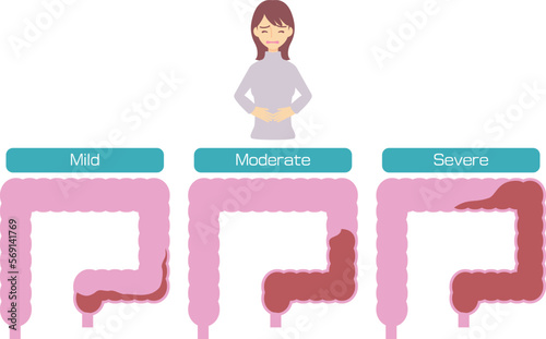 便秘の軽症から重症までの様子／Condition of constipation from mild to severe