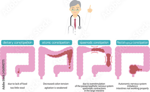 便秘の原因別種類を図解／Illustrated types of constipation by cause