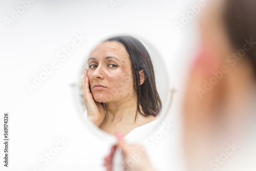 Photo of woman having skin problems looking in the mirror.