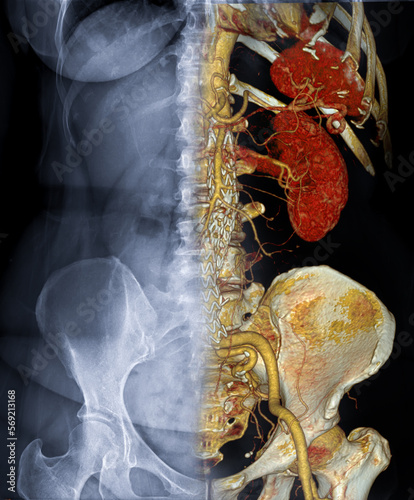 CTA ABDOMINAL AORTA  3D rendering fusion with  X-ray Abdomen image. photo