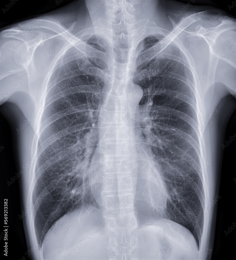 Chest x-ray image for screening diagnosis TB,tuberculosis and covid-19. Chest x-ray image for screening diagnosis TB,tuberculosis and covid-19.