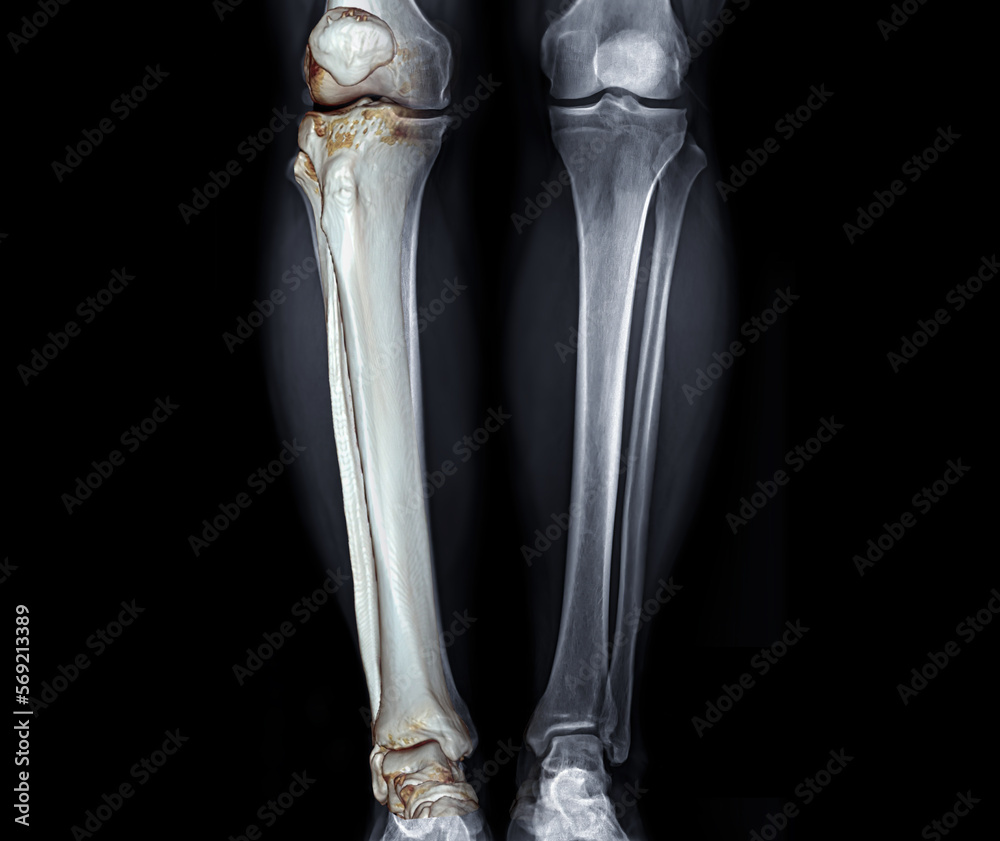X-ray image of both Leg AP view with 3D leg for diagnostic knee fracrure. X-ray image of both Leg AP view with 3D leg for diagnostic knee fracrure.