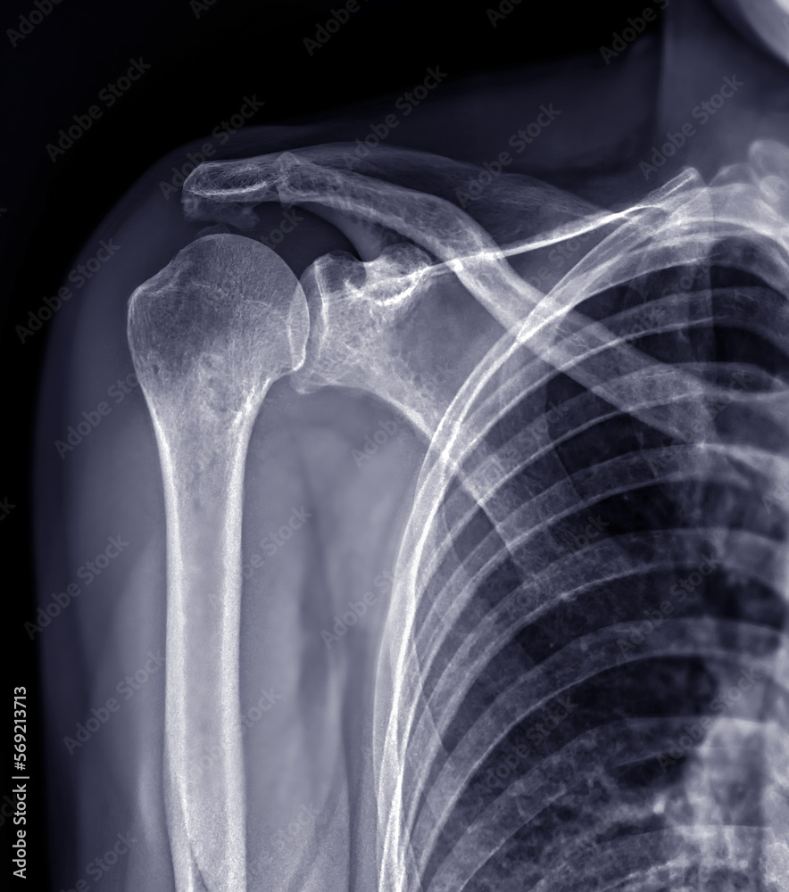 X-ray Shoulder joint shoulder front view for diagnosis fracture of shoulder joint. X-ray Shoulder joint shoulder front view for diagnosis fracture of shoulder joint.