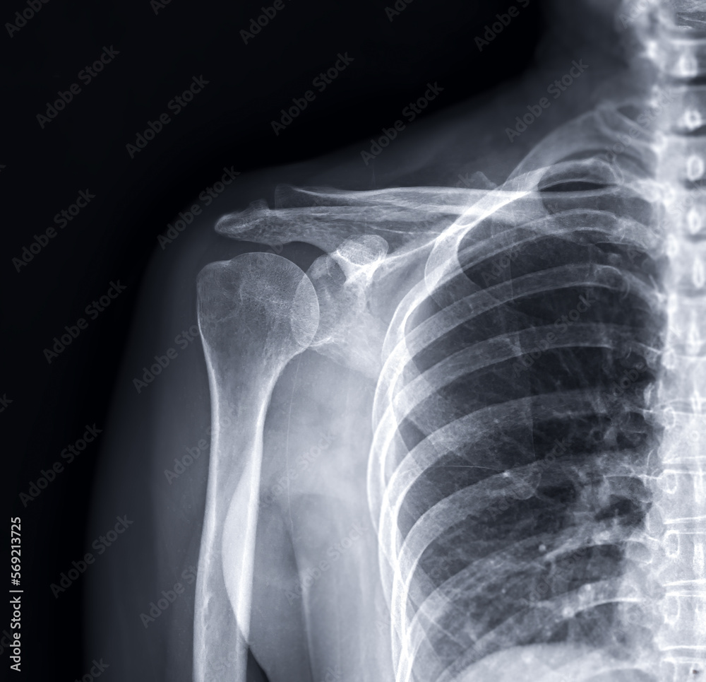X-ray Shoulder joint shoulder front view for diagnosis fracture of shoulder joint. X-ray Shoulder joint shoulder front view for diagnosis fracture of shoulder joint.