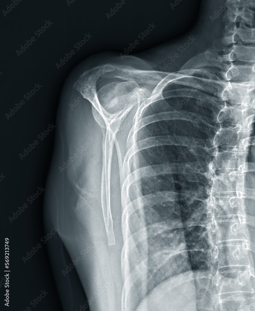 X-ray Shoulder joint shoulder front view for diagnosis fracture of shoulder joint. X-ray Shoulder joint shoulder front view for diagnosis fracture of shoulder joint.