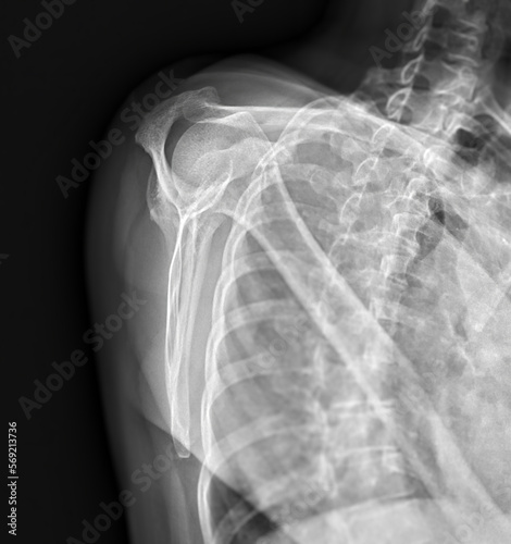 X-ray Shoulder joint shoulder front view for diagnosis fracture of shoulder joint.