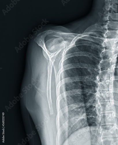 X-ray Shoulder joint shoulder front view for diagnosis fracture of shoulder joint.