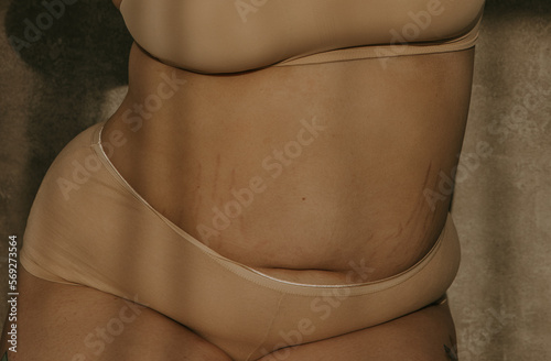 close up of a plus size filipino belly with stretchmarks