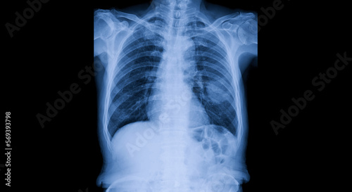 Billede på lærred The radiograph on dark background in a hospital