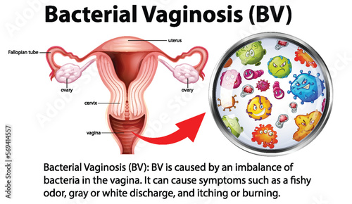 Bacterial Vaginosis (BV) infographic with explanation