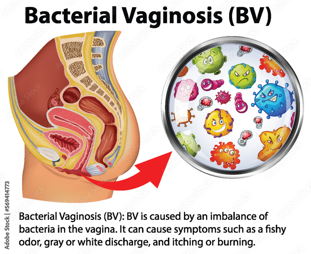 Bacterial Vaginosis Infographic With Explanation Stock Vector Adobe Stock