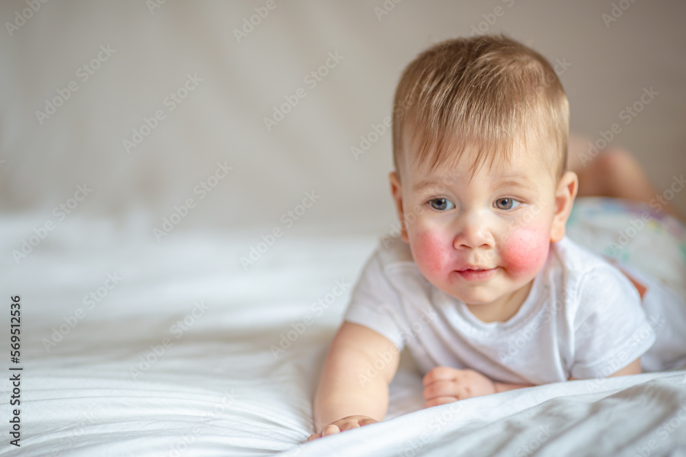 Atopic dermatitis eczema in baby.Condition that causes the skin to become red,dry,sore,itchy and cracked.Atopic eczema most often affects face in children. London England UK,Mart 30 2020