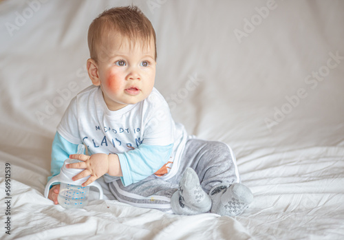 Atopic dermatitis eczema in baby.Condition that causes the skin to become red,dry,sore,itchy and cracked.Atopic eczema most often affects face in children. London England UK,Mart 30 2020