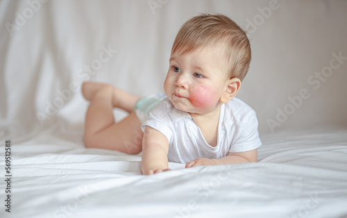 Atopic dermatitis eczema in baby.Condition that causes the skin to become red,dry,sore,itchy and cracked.Atopic eczema most often affects face in children. London England UK,Mart 30 2020