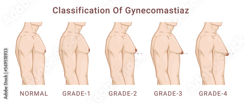 Classification of gynecomastia enlargement male breast steps medical scheme vector flat illustration