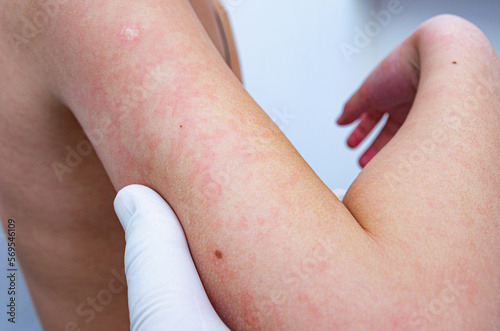 8 years old child with red skin- enterovirus infection, diathesis, urticaria or allergy symptoms. Redness and peeling of the skin on the body.