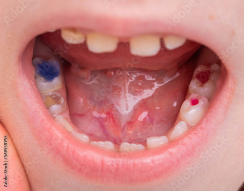 Child's mouth with multi-colored red and blue dental fillings after dental treatment in pediatric dentistry. Modern technology for children.