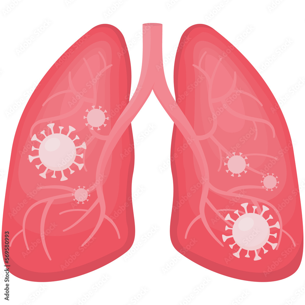 Flat vector illustration of human lungs under viral pneumonia and covid. Coronavirus in your infected organs, close up view on virus cells, detail outline of anatomy isolated.