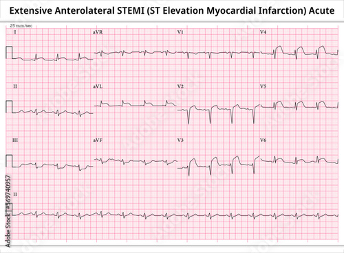 Extensive Anterolateral STEMI (ST-Elevation Myocardial Infarction) Acute - ECG Paper 12 Lead - Vector Medical Illustration