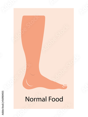 Lymphedema stages. Lymphatic system dysfunction disease. Swollen legs, lymph fluid transportation disorder. Flat vector illustration © visio