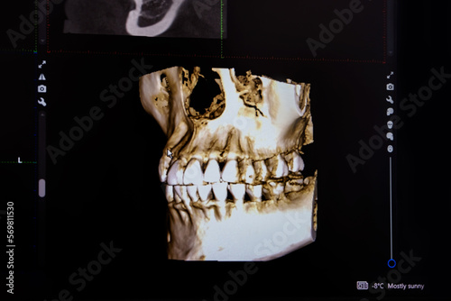 Close up photo panoramic x-ray of the jaw on a computer screen. The doctor shows a 3D model of the patient's mouth, MRI scan. Diagnostic equipment for teeth in a modern dental clinic. photo