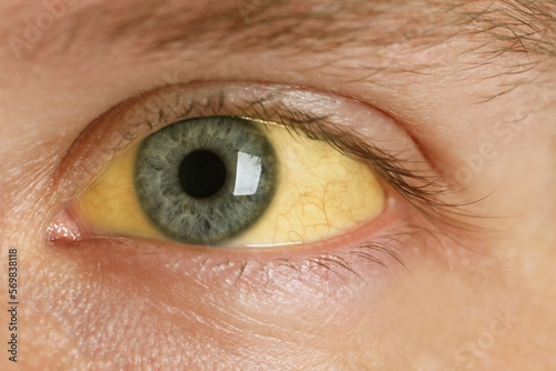 Man with yellow eyes, closeup view. Symptom of hepatitis