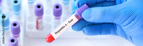 The doctor holds a test blood sample tube positive with hepatitis A virus (HAV) test on the background of medical test tubes. Banner