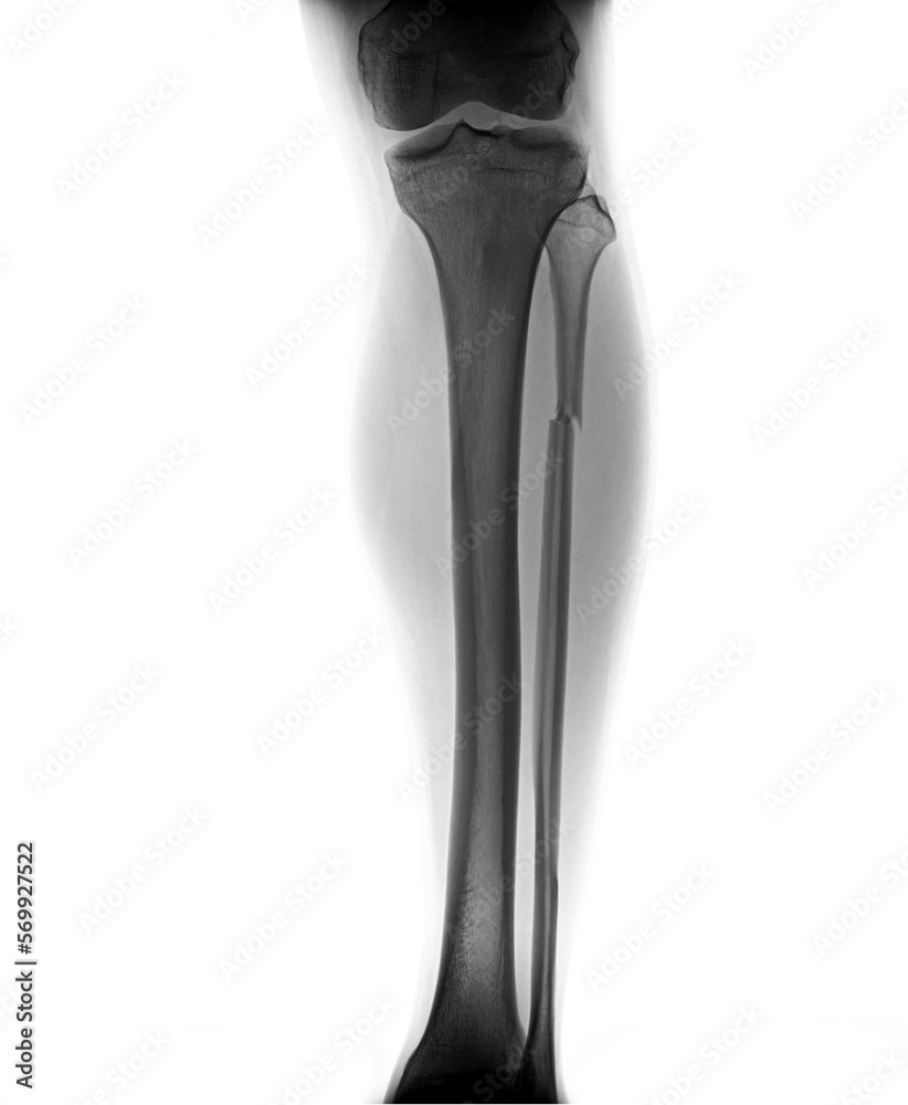 X-ray image of fracture leg bone X-ray image of fracture leg bone