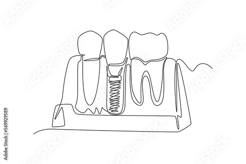 Continuous one line drawing Teeth with dental implant. Dental health concept. Single line draw design vector graphic illustration.