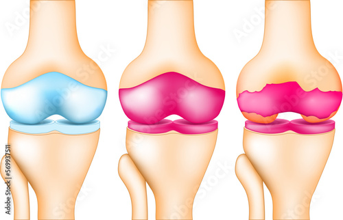 stage of knee cartilage destruction. 