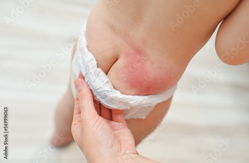 Tableau sur toile irritation on the skin of the baby from the diaper