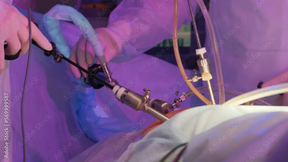 Vidéo Stock Laparoscopic cholecystectomy instrument. The surgeon's doing laparoscopic gastric