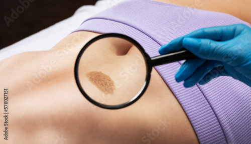 On the woman's stomach, the doctor examines the problem area of the skin with a large mole.