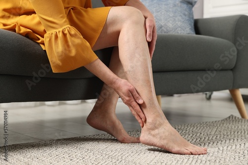 Barefoot woman with varicose veins on sofa in room, closeup photo