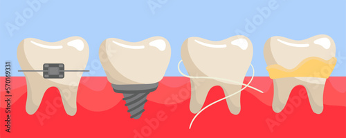 A set of teeth on the gums with braces, a false tooth, clean with dental floss, with tartar and plaque. The teeth are different on the gums. Illustration in a flat style