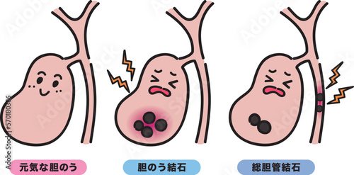 元気な胆のう・胆のう結石・総胆管結石のセット