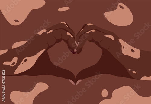 Two hands with vitiligo patches in the shape of a heart. Self love concept. World Vitiligo Day. I love my skin. Brown skin with a patch of vitiligo. Skin diseases. Self care 