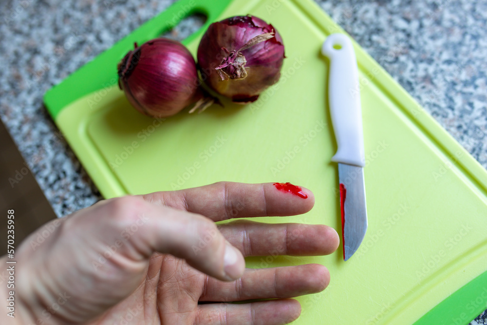 Beim Zwiebeln schneiden in den Finger geschnitten. Blut an Finger und Messer. Stock Photo