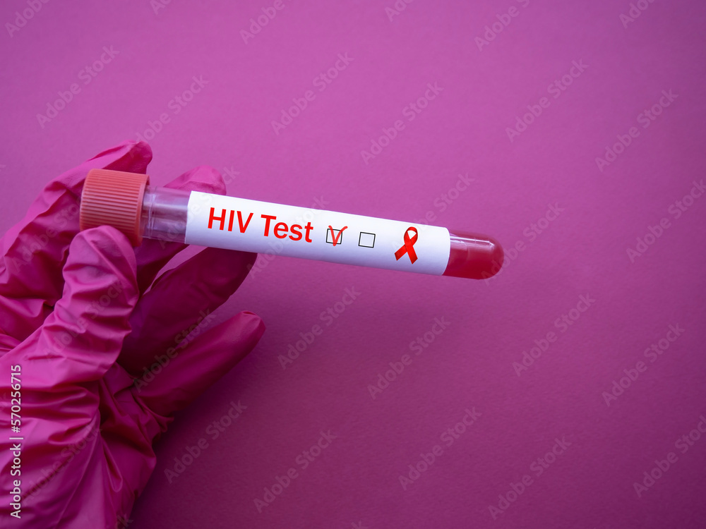 Blood collection tube with HIV test. The doctor's hand holds a positive