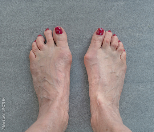 White female feet with bunion or hallux valgus.